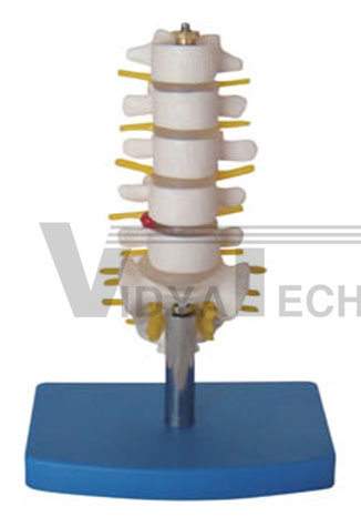 Half-size lumbar vertebrae with sacrum & coccyx and herniated disc